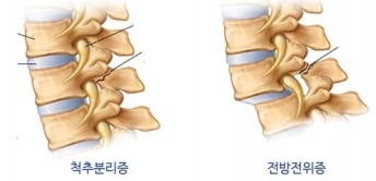 경상일보 160504 - [청진기]허리뼈 끊어진 척추분리증, 어긋난 전방전위증